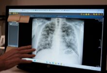 Lung cancer: a scan that detects early and an injection that may prevent it