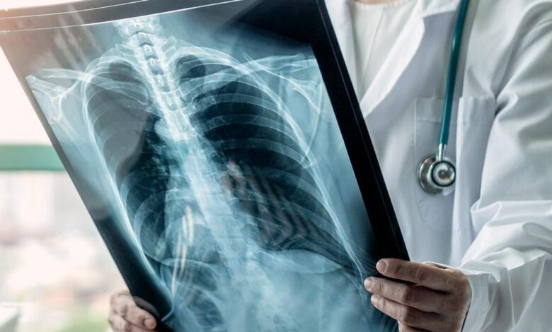 Can lung cancer be prevented using a drug?